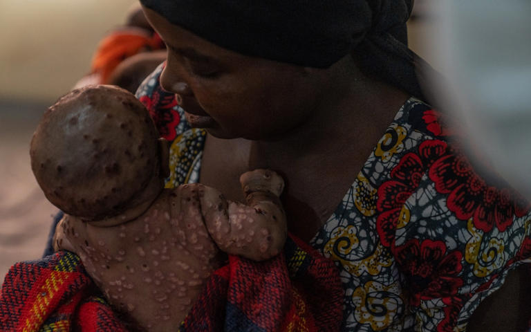 Child Mpox Deaths Surge in DRC Amid Supply Shortages and Sanitation Crisis