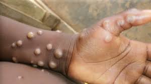 Global Effort to Curb Mpox: Vaccinations and Vigilance Key to Prevention
