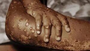 Africa ends mpox emergency following sharp fall in infections mpox