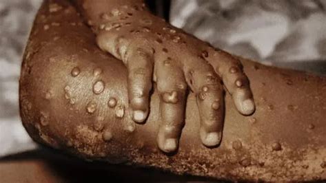 UK on High Alert Over Concerns of New Mpox Strain.