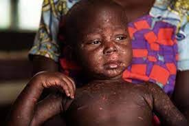 Measles upsurge: Under-five children more at risk – WHO