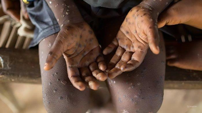Mpox: Ghana health director confirms new case