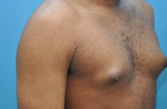 Man with large breast