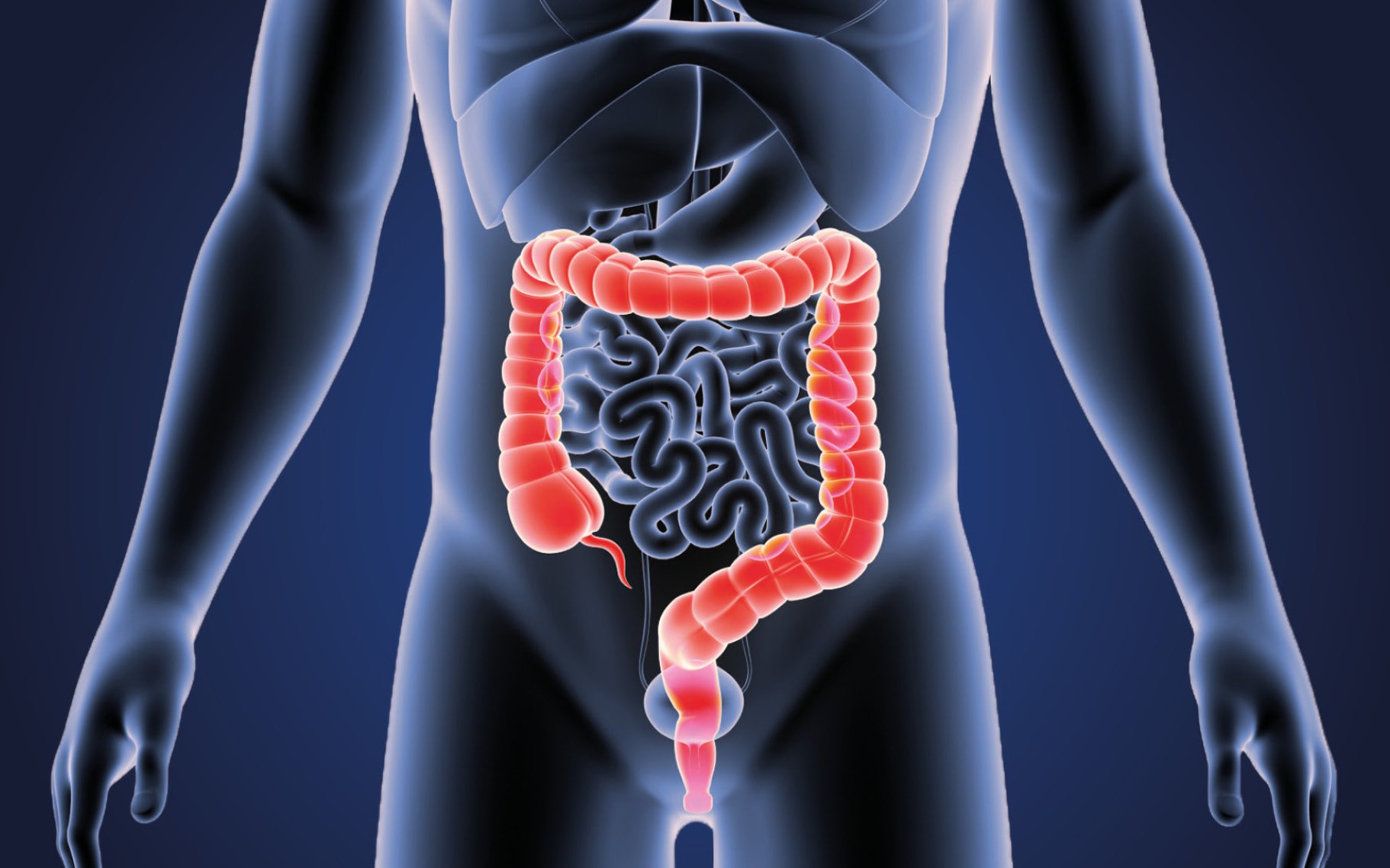 Bowel cancer is rising in Nigeria – Is a lack of fibre hidden cause?